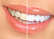 Professional teeth whitening is the only solution to give teeth the natural white look.